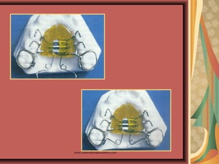 Pendulum appliance 2 /certified fixed orthodontic courses by Indian dental academy 