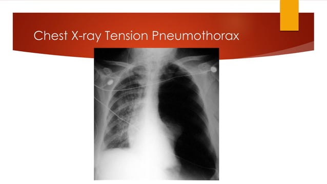 Penetrating Chest Injury.pdf