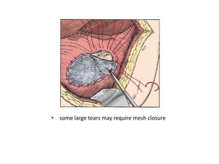 Open Heart Incision Closure Mesh Penetrating chest trauma | PPTX