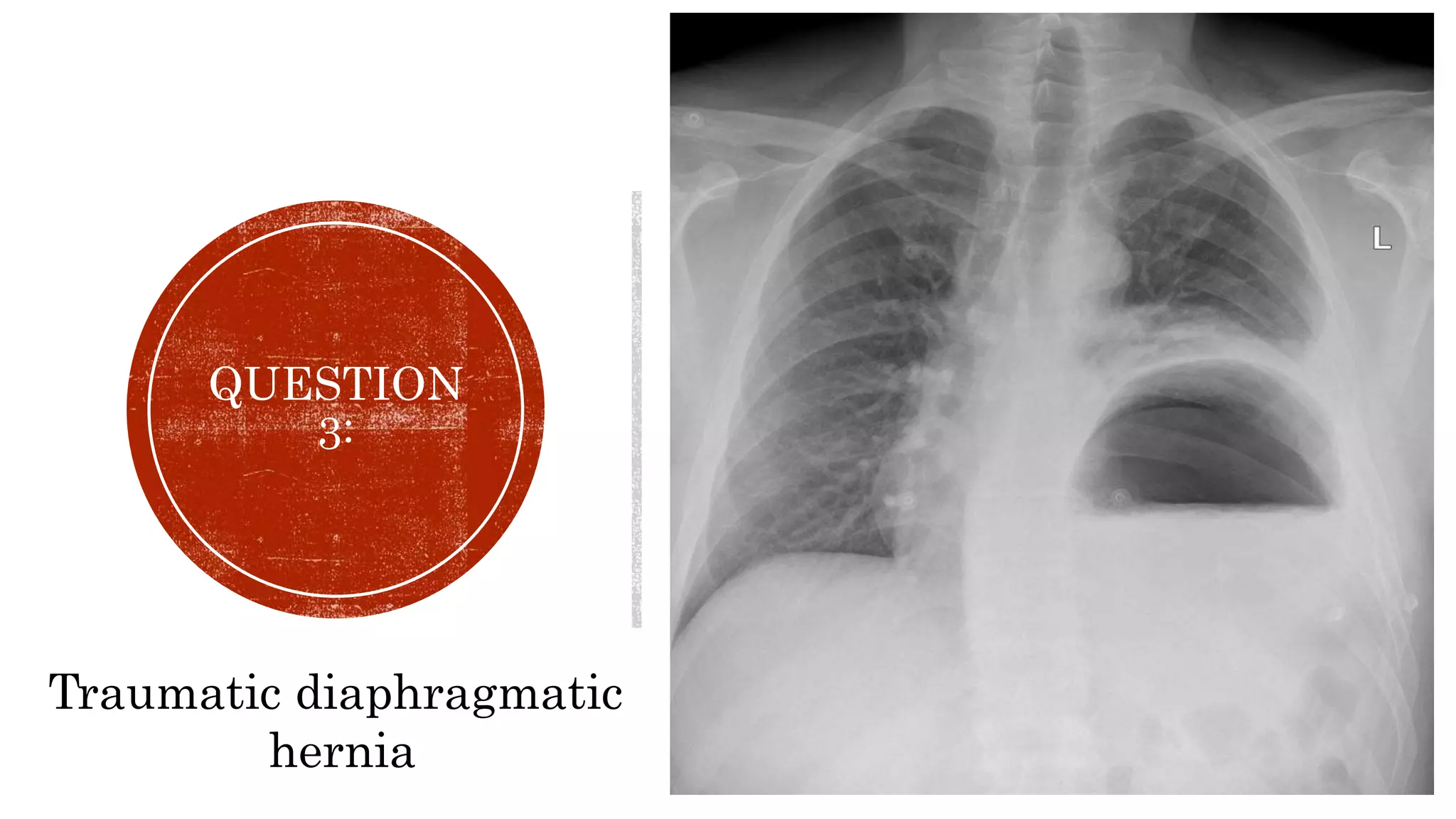 Penetrating chest trauma.pptx