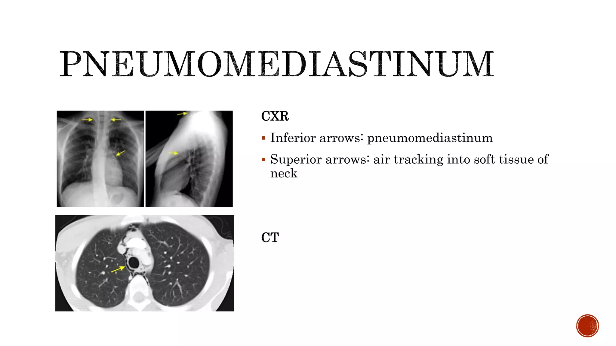Penetrating chest trauma.pptx