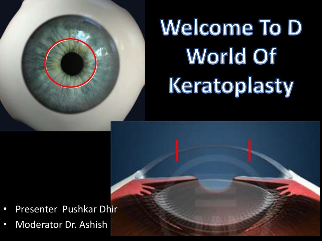 keratoplasty by pushkar dhir