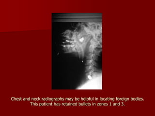Chest and neck radiographs may be helpful in locating foreign bodies.
This patient has retained bullets in zones 1 and 3.
 