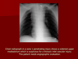 Chest radiograph in a zone 1 penetrating injury shows a widened upper
mediastinum which is suspicious for a thoracic inlet vascular injury.
This patient needs angiographic evaluation.
 