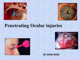Penetrating Ocular injuries BY JOHN XXXX 
