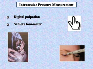   Intraocular Pressure MeasurementDigital palpationSchiotz tonometer