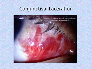 Conjunctival Laceration