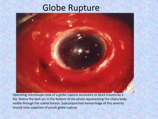 Globe RuptureOperating microscope view of a globe rupture secondary to blunt trauma by a fist. Notice the dark arc in the bottom of the photo representing the ciliary body visible through the scleral breach. Subconjunctival hemorrhage of this severity should raise suspicion of occult globe rupture