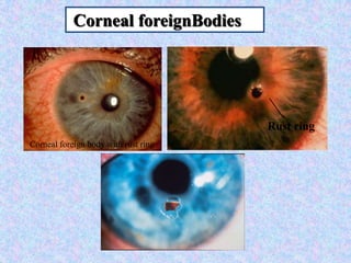 Corneal foreignBodiesRust ringCorneal foreign body with rust ring