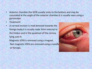 Anterior chamber:the IOFB usually sinks to the bottom and may be concealed at the angle of the anterior chamber.It is usually seen using a gonoscope.Treatment:A corneal incision is mad directed towards the      foreign body.it is usually nade 3mm internal to       the limbus and in the quadrant of the cornea       lying over it.      Magnetic IOFB is removed using a magnet.       Non magnetic IOFb are removed using a needle       or forceps.