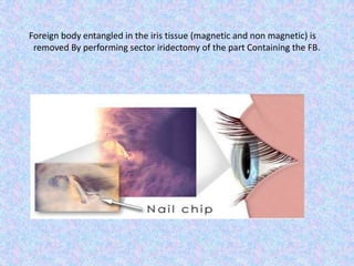     Foreign body entangled in the iris tissue (magnetic and non magnetic) is removed By performing sector iridectomy of the part Containing the FB.