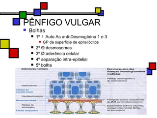 PÊNFIGO VULGAR
 Bolhas
 1º ↑ Auto Ac anti-Desmogleína 1 e 3
 GP da superficie de epiteliócitos
 2º Θ desmosomas
 3º Ø aderência celular
 4º separação intra-epitelial
 5º bolha
 
