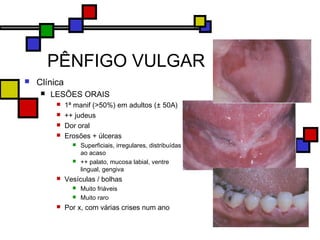 PÊNFIGO VULGAR
 Clínica
 LESÕES ORAIS
 1ª manif (>50%) em adultos (± 50A)
 ++ judeus
 Dor oral
 Erosões + úlceras
 Superficiais, irregulares, distribuídas
ao acaso
 ++ palato, mucosa labial, ventre
lingual, gengiva
 Vesículas / bolhas
 Muito friáveis
 Muito raro
 Por x, com várias crises num ano
 