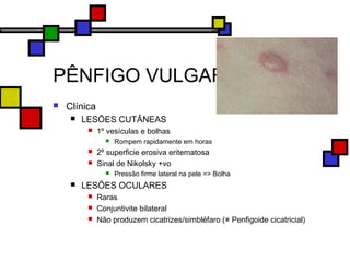PÊNFIGO VULGAR
 Clínica
 LESÕES CUTÂNEAS
 1º vesículas e bolhas
 Rompem rapidamente em horas
 2º superficie erosiva eritematosa
 Sinal de Nikolsky +vo
 Pressão firme lateral na pele => Bolha
 LESÕES OCULARES
 Raras
 Conjuntivite bilateral
 Não produzem cicatrizes/simbléfaro (≠ Penfigoide cicatricial)
 