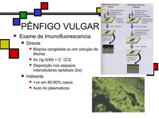 PÊNFIGO VULGAR
 Exame de Imunofluorescencia
 Directa
 Biópsia congelada ou em solução de
Michel
 Ac (Ig G/M) + C´ (C3)
 Deposição nos espaços
intercelulares epiteliais (Dx)
 Indirecta
 +vo em 80-90% casos
 Auto Ac plasmaticos
 