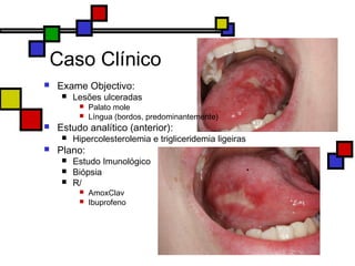 Caso Clínico
 Exame Objectivo:
 Lesões ulceradas
 Palato mole
 Língua (bordos, predominantemente)
 Estudo analítico (anterior):
 Hipercolesterolemia e trigliceridemia ligeiras
 Plano:
 Estudo Imunológico
 Biópsia
 R/
 AmoxClav
 Ibuprofeno
 