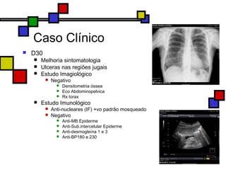 Caso Clínico
 D30
 Melhoria sintomatologia
 Ulceras nas regiões jugais
 Estudo Imagiológico
 Negativo
 Densitometria óssea
 Eco Abdominopelvica
 Rx torax
 Estudo Imunológico
 Anti-nucleares (IF) +vo padrão mosqueado
 Negativo
 Anti-MB Epiderme
 Anti-Sub.intercelular Epiderme
 Anti-desmogleína 1 e 3
 Anti-BP180 e 230
 