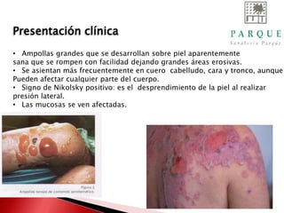 Presentación clínica
• Ampollas grandes que se desarrollan sobre piel aparentemente
sana que se rompen con facilidad dejando grandes áreas erosivas.
• Se asientan más frecuentemente en cuero cabelludo, cara y tronco, aunque
Pueden afectar cualquier parte del cuerpo.
• Signo de Nikolsky positivo: es el desprendimiento de la piel al realizar
presión lateral.
• Las mucosas se ven afectadas.
 
