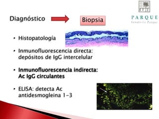 • Histopatología
• Inmunofluorescencia directa:
depósitos de IgG intercelular
• Inmunofluorescencia indirecta:
Ac IgG circulantes
• ELISA: detecta Ac
antidesmogleina 1-3
Diagnóstico Biopsia
 