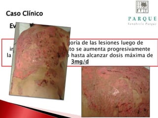 Por no presentar mejoría de las lesiones luego de
instaurado el tratamiento se aumenta progresivamente
la dosis de micofenolato hasta alcanzar dosis máxima de
3mg/d
Caso Clínico
Evolución
 