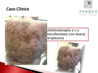 Realizó 7 días de antibióticoterapia e.v y
16 días de corticoides y micofenolato con buena
respuesta terapéutica
Caso Clínico
Evolución
 