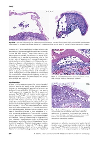 Olivry




Figure 13. Canine (left) and feline (right) PF. In these early microscopic lesions, ﬂuid-ﬁlled vesico-pustules contain few neutrophils and acantholytic
keratinocytes. The sample on the right was obtained as a shave biopsy from an auricular lesion not existing 2 h before (haematoxylin and eosin).



clustered (e.g. ‘rafts’) free-ﬂoating rounded keratinocytes
admixed with nondegenerated neutrophils and rarer eosi-
nophils are seen usually.5–7 Acantholytic keratinocytes
exhibit either microscopic characteristics of normal differ-
entiated spinous or granular layer epithelial cells, or they
present signs of apoptosis with eosinophilic cytoplasm,
condensed chromatin or karyorrhexis. Occasionally, neu-
trophils can be seen in close apposition to detached kerat-
inocytes. The presence of acantholytic keratinocytes and
neutrophils is not speciﬁc of PF, however. Similar micro-
scopical ﬁndings have been found in canine and equine
cases of pustular dermatophytosis, a PF mimicker in
which Trichophyton fungi invade the stratum corneum and
induce subcorneal acantholytic neutrophilic pustules.46 – 48
Keratinocyte acantholysis has been reported also in dogs                       Figure 14. Canine PF. Intraepidermal vesico-pustule in the granular
with bacterial skin infections.38                                              layer of footpad epidermis (haematoxylin and eosin).


Histopathology
In dogs, cats, horses and goats with PF, histological exam-
ination of lesional skin reveals similar ﬁndings. Very early
lesions may be vesicles with acantholytic keratinocytes
and scarce neutrophils (Fig. 13). However, these lesions
rapidly evolve into intragranular (Fig. 14) or subcorneal
pustules (Figs 13,14,15) with isolated and /or clustered
acantholytic cells.5,6,38,39 In these lesions, neutrophils pre-
dominate, but variable numbers of eosinophils may be
found.5–7,38,39 Pustules commonly invade the epithelium
and /or the lumen of the follicular infundibulum.5,38 In gen-
eral, the pustules are large and span the length of multiple
follicular units, a ﬁnding that differentiates these lesions
from those of bacterial folliculitis.12,38 Similarly, recorniﬁca-
tion, deﬁned as newly reformed stratum corneum at the                          Figure 15. Canine PF. Intraepidermal to subcorneal neutrophilic
base of neutrophilic pustules, is more suggestive of PF                        and eosinophilic pustule with single and clustered acantholytic
(Fig. 16) than bacterial folliculitis.38 Microscopic character-                keratinocytes. Of interest is the ‘keratin ﬁlament ring’ that can be
istics of acantholytic keratinocytes mirror those observed                     seen in acantholytic or pre-acantholytic keratinocytes (arrowheads)
                                                                               from the presumed detachment of keratin ﬁlaments from
with cytology. Epidermal cells that recently detached from
                                                                               desmosomes (haematoxylin and eosin).
their neighbours usually appear similar to differentiated
keratinocytes whilst other cells exhibit cytological charac-
teristics of apoptosis.5 Apoptotic keratinocytes are seen                      apoptosis may reﬂect the phenomenon of anoikis that fol-
often in the epidermis of dogs with PF,49 and as a result                      lows the rupture of desmosomal cadherin adhesion during
these apoptotic epidermal cells cannot be taken for bona                       acantholysis.50 Alternatively, activation of the apoptotic
ﬁde markers of underlying drug reactions. The induction of                     pathway could be an early consequence of the binding of


296                                           © 2006 The Author. Journal compilation © 2006 European Society of Veterinary Dermatology.
 