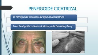 El Penfigoide cicatrizal de tipo mucocutáneo
En el Penfigoide cutáneo cicatrizal, o de Brunsting-Perry
PENFIGOIDE CICATRIZAL
 
