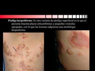 Pénfigo herpetiforme: Es otra variante de pénfigo superficial en la que el
paciente muestra placas urticariformes y pequeñas vesículas
agrupadas, con lo que las lesiones adquieren una morfología
herpetiforme.
 