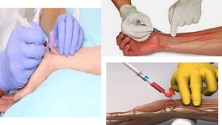 Comprehensive Guide to Arterial Blood Sampling Procedures and Analysis ...