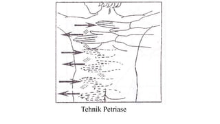 Tehnik Petriase
 
