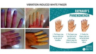 VIBRATION INDUCED WHITE FINGER
 