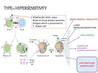 TYPE-1HYPERSENSITIVITY
BOOD VESSELS- VASCULITIS
LUNGS-
BRONCHOCONSTRICTION
SKIN- RASHES
GLOMERULAR
CAPILLARIES-
GLOMERULAR NEPHRITIS
PENICILLOIC ACID- when
Binds to tissue protein becomes
Antigen which is presented to
T- Helper cell.
LATE REACTION-
ANAPHYLAXIS
 