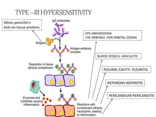TYPE–IIIHYPERSENSITIVITY
When penicillin's
Acts on tissue proteins
LIPS-ANGIOEDEMA
EYE ORBITALS- PERI ORBITAL EDEMA
BLOOD VESSELS- VASCULITIS
NEPHRONS-NEPHRITIS
PLEURAL CAVITY- PLEURITIS
PERICARDIUM-PERICARDITIS
 