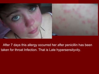 After 7 days this allergy occurred her after penicillin has been
taken for throat Infection. That is Late hypersensityvity.
 
