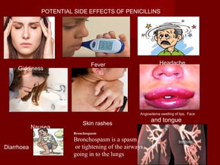 Nausea
Skin rashes
HeadacheFever
Giddiness
Angioedema swelling of lips, Face
and tongue
Bronchospasm
Bronchospasm is a spasm
or tightening of the airways
going in to the lungs
POTENTIAL SIDE EFFECTS OF PENICILLINS
Diarrhoea
 