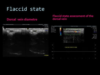 Flaccid state
                       Flaccid state assessment of the
Dorsal vein diametre   dorsal vein
 