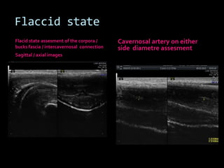 Flaccid state
Flacid state assesment of the corpora /     Cavernosal artery on either
bucks fascia / intercavernosal connection   side diametre assesment
Sagittal / axial images
 