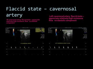 Flaccid state – cavernosal
artery          Left cavernosal artery flaccid state –
                appreciate relatively high resistance
 Rt cavernosal artery flaccid state – appreciate
relatively high resistance flow no diastolic       flow no diastolic component
component
 