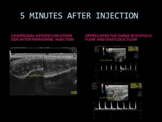 5 MINUTES AFTER INJECTION

CAVERNOSAL ARTERIES ON EITHER     APPRECIATED THE SURGE IN SYSTOLIC
SIDE AFTER PAPAVERINE INJECTION   FLOW AND DIASTLOLIC FLOW
 