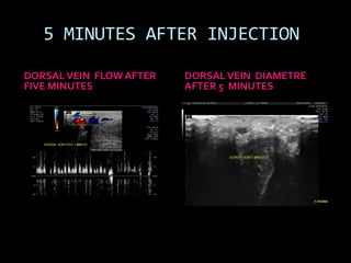 5 MINUTES AFTER INJECTION

DORSAL VEIN FLOW AFTER   DORSAL VEIN DIAMETRE
FIVE MINUTES             AFTER 5 MINUTES
 