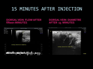 15 MINUTES AFTER INJECTION

DORSAL VEIN FLOW AFTER   DORSAL VEIN DIAMETRE
fifteen MINUTES          AFTER 15 MINUTES
 