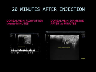 20 MINUTES AFTER INJECTION

DORSAL VEIN FLOW AFTER   DORSAL VEIN DIAMETRE
twenty MINUTES           AFTER 20 MINUTES
 