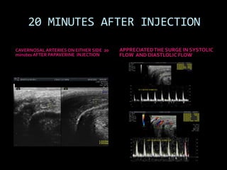 20 MINUTES AFTER INJECTION

CAVERNOSAL ARTERIES ON EITHER SIDE 20   APPRECIATED THE SURGE IN SYSTOLIC
minutes AFTER PAPAVERINE INJECTION      FLOW AND DIASTLOLIC FLOW
 