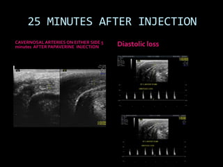 25 MINUTES AFTER INJECTION
CAVERNOSAL ARTERIES ON EITHER SIDE 5
minutes AFTER PAPAVERINE INJECTION     Diastolic loss
 