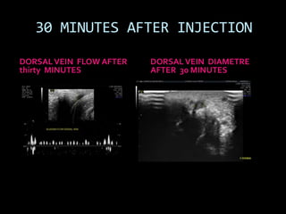 30 MINUTES AFTER INJECTION

DORSAL VEIN FLOW AFTER   DORSAL VEIN DIAMETRE
thirty MINUTES           AFTER 30 MINUTES
 