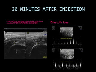 30 MINUTES AFTER INJECTION

CAVERNOSAL ARTERIES ON EITHER SIDE thirty
minutes AFTER PAPAVERINE INJECTION          Diastolic loss
 