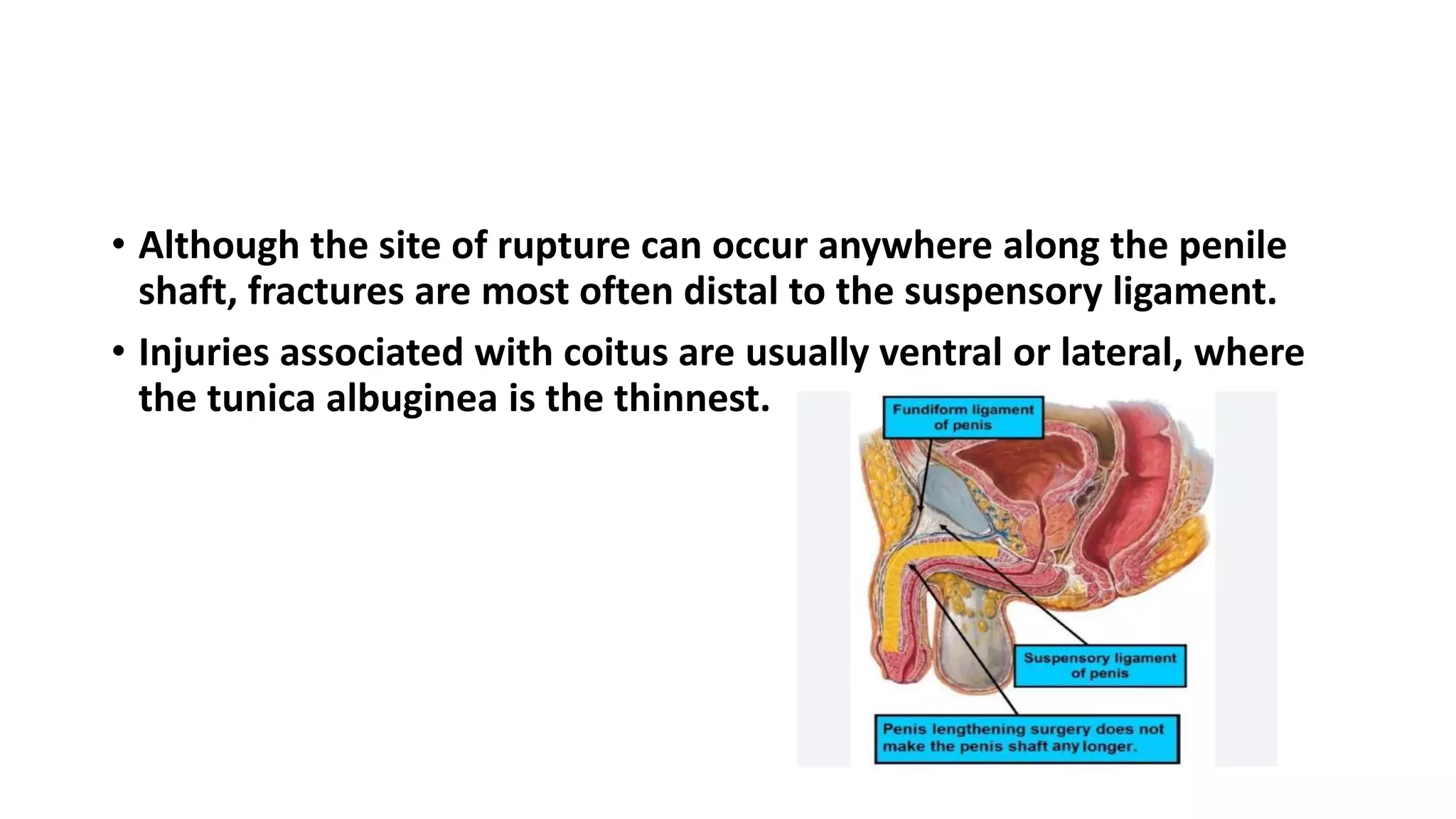 PENILE FRACTURE.pptx — free download