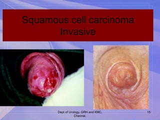 Penis carcinoma- overview