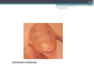 NEWBORN PHIMOSIS
22
Dept of Urology, GRH
and KMC, Chennai.
 