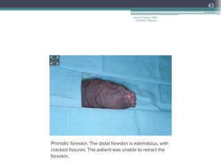 43
Dept of Urology, GRH
and KMC, Chennai.
 